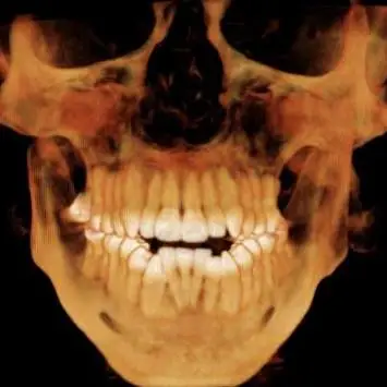 3D CT reconstruction of a human upper and lower jaw in bronze tones, with all teeth visible in occlusion. The reconstruction shows the alveolar bone architecture supporting the dentition in a patient with Hajdu-Cheney Syndrome.