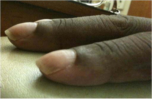 Digital clubbing in POEMS syndrome showing bulbous enlargement of the fingertip