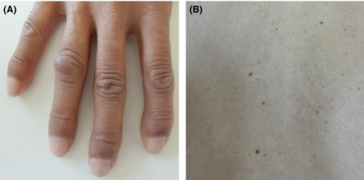 POEMS syndrome skin changes: (A) leukonychia (white nails) with cutaneous papules, (B) skin thickening