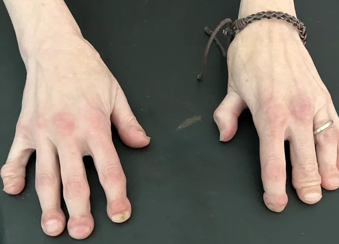 A pair of hands laid flat, the tips are bulbous and the fingers are shortened.