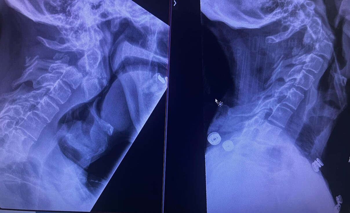 Two lateral cervical spine X-rays displayed side by side on a clinical monitor, showing distorted vertebral architecture and instability typical of an HCS patient with basilar invagination and cervical compromise.