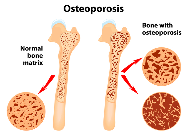 Educational illustration comparing a normal femur with an osteoporotic femur. On the left, dense trabecular bone with a tightly woven internal matrix; on the right, sparse and thinned trabeculae. Two magnified circular insets show the same contrast between dense and degraded bone architecture.