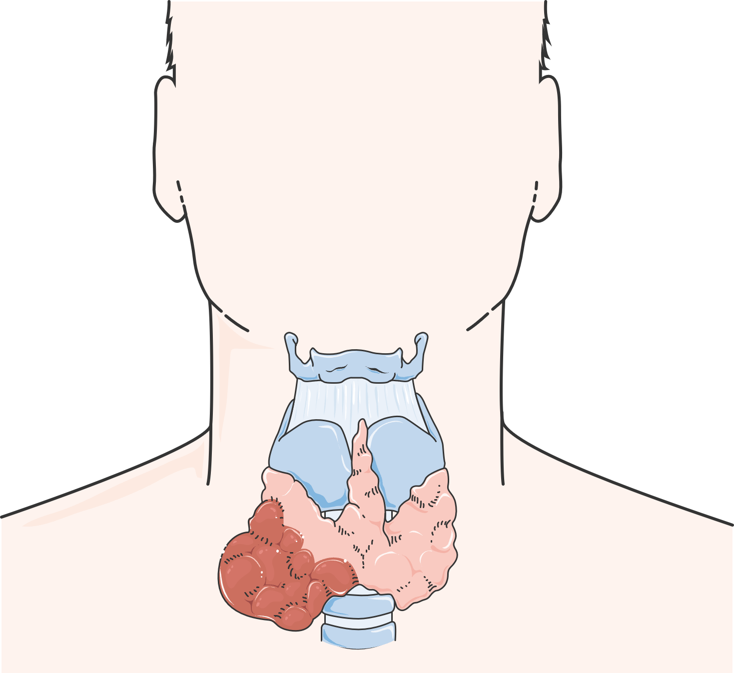 Illustration of the thyroid gland — hypothyroidism is a common endocrine complication in POEMS syndrome