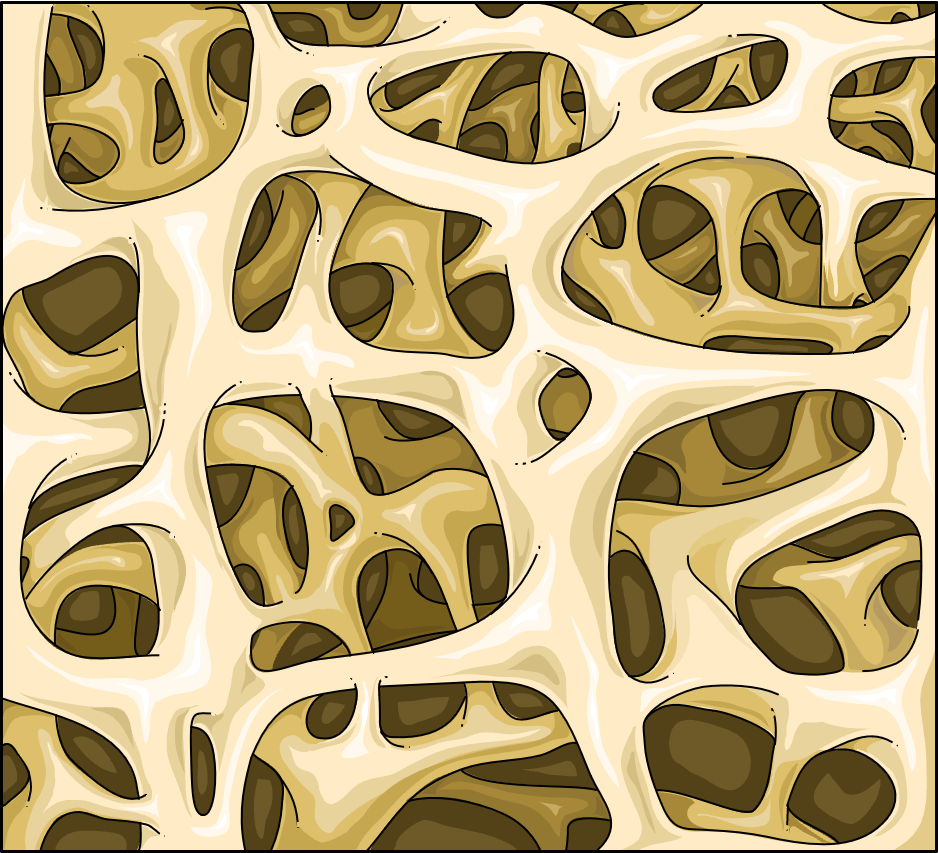 Illustration of trabecular bone structure showing the internal meshwork that becomes abnormally dense (sclerotic) in POEMS syndrome