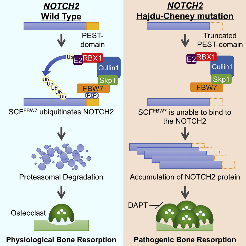 Two-column diagram comparing wild-type NOTCH2 (left, blue background) with Hajdu-Cheney mutant NOTCH2 (right, peach background). Wild-type NOTCH2 has an intact PEST domain and is recognised and ubiquitinated by the SCF-FBW7 complex (E2, RBX1, Cullin1, Skp1, FBW7), routed to proteasomal degradation, producing physiological osteoclast activity and normal bone resorption. The Hajdu-Cheney mutant has a truncated PEST domain, escapes SCF-FBW7 recognition, accumulates as protein, and drives pathogenic osteoclast activity with excessive bone resorption; DAPT, a gamma-secretase inhibitor, is shown as a candidate therapeutic at the top of the mutant pathway.