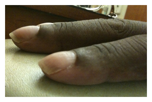 POEMS syndrome skin changes: close-up clinical photograph of two fingers showing leukonychia (white discolouration of the nails)