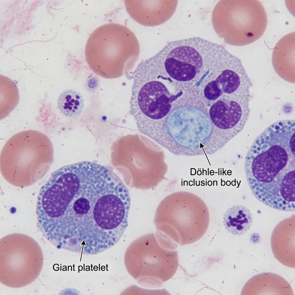 Blood smear showing D&ouml;hle-like inclusion bodies under immunofluorescence staining, highlighting the MYH9 protein distribution in neutrophils