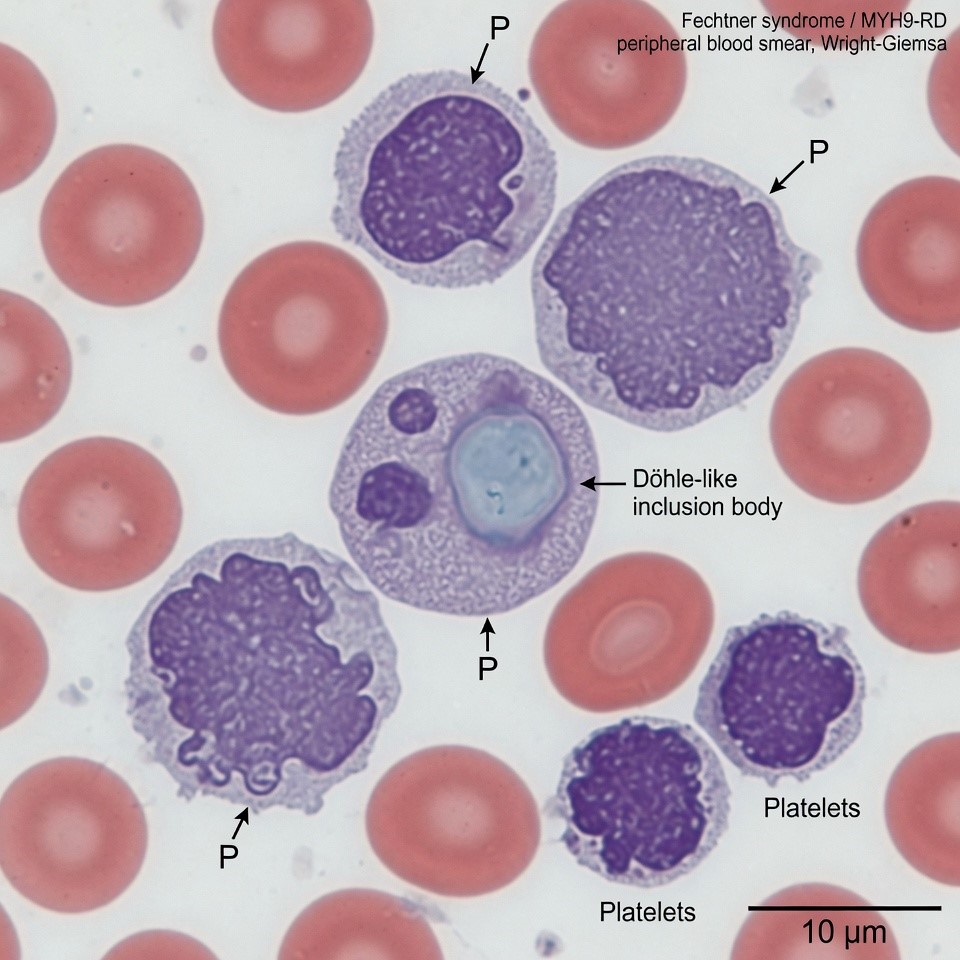 Microscopy image showing D&ouml;hle-like inclusion bodies inside white blood cells, a hallmark diagnostic sign of MYH9-Related Disease