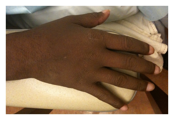 POEMS syndrome: clinical photograph of a patient's hand showing digital clubbing with bulbous enlargement of the fingertips