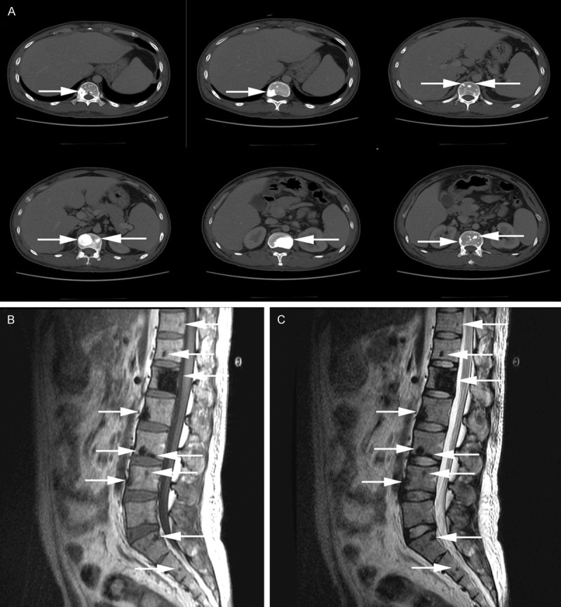 POEMS syndrome multi-system imaging: Panel A, axial CT slices demonstrating organomegaly and extravascular volume overload; Panels B and C, sagittal MRI sequences showing multiple sclerotic vertebral lesions (arrows) through the thoracolumbar spine