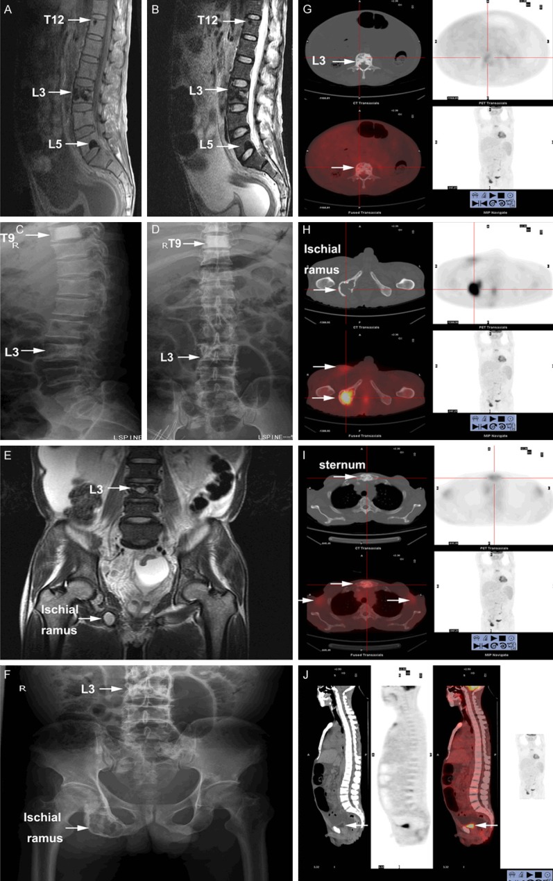 Multimodal imaging of POEMS bone lesions: ten panels showing sclerotic lesions at T12, L3, L5, ischial ramus, and sternum across MRI, CT, plain radiography, and PET/CT