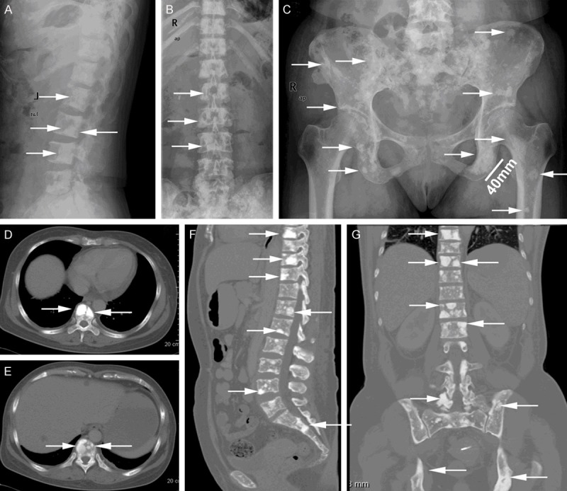 POEMS syndrome skeletal survey: Panels A through C, plain radiographs of the spine and pelvis with arrows marking sclerotic bone lesions; Panels D through G, corresponding CT slices confirming the same lesions with higher sensitivity